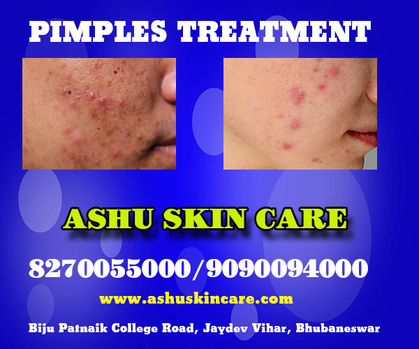 best pimples treatment clinic in bhubaneswar not far from kar hospital